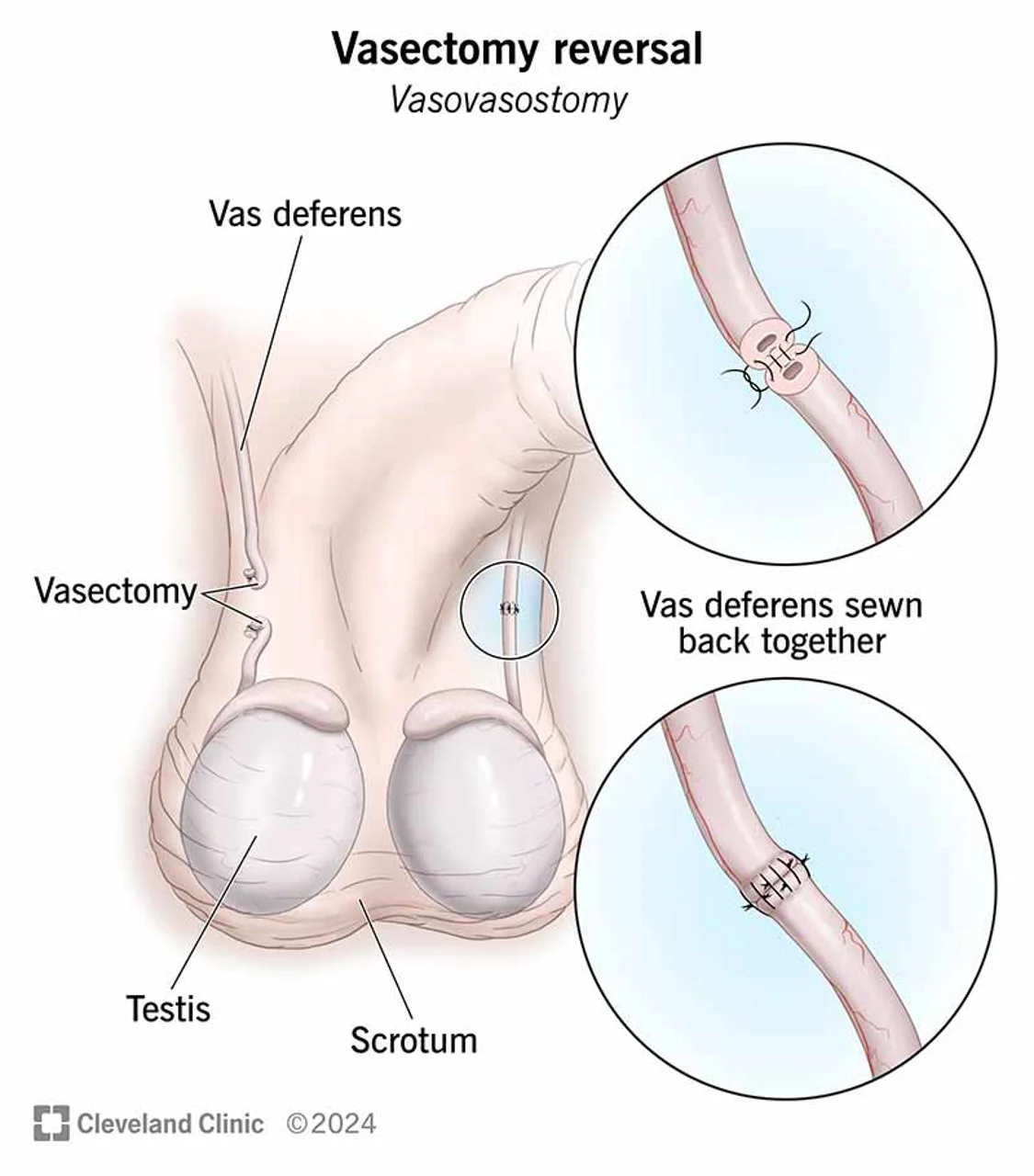 معکوس وازکتومی  vasectomy reversal یا vasovasostomy